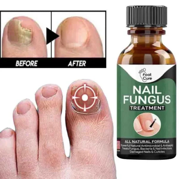 Fast Nail Fungus Treatment & Repair Serum – Anti-Fungal Nail Care Gel for Healthy, Strong Nails