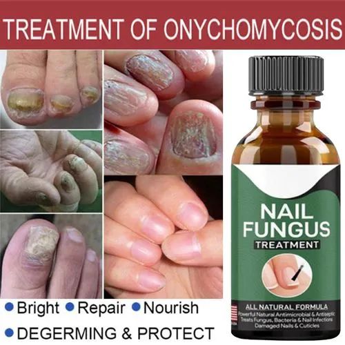 Fast Nail Fungus Treatment & Repair Serum – Anti-Fungal Nail Care Gel for Healthy, Strong Nails